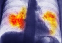 Common Disinfectants like Bleach lead to higher risk of Fatal Lung Disease Exposure to the fumes could cause the fatal disease to develop