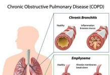 The effect of Statins may help people with COPD live longer The effect of statins may help people with COPD live longer