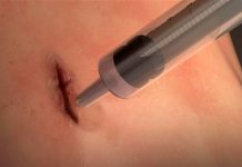 New Surgical Glue has Been Invented Which Heals Wound in 60 Seconds New Surgical Glue has Been Invented Which Heals Wound in 60 Seconds