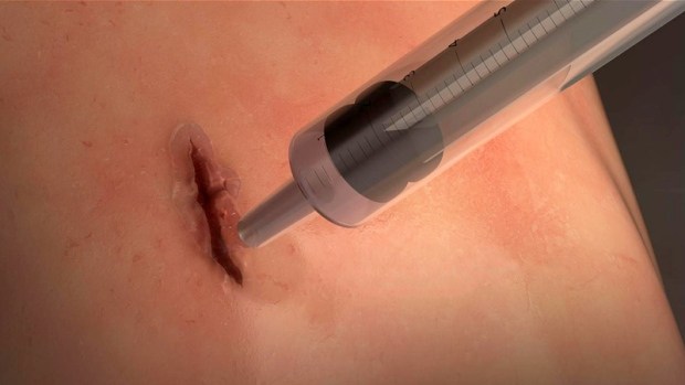 New Surgical Glue has Been Invented Which Heals Wound in 60 Seconds New Surgical Glue has Been Invented Which Heals Wound in 60 Seconds