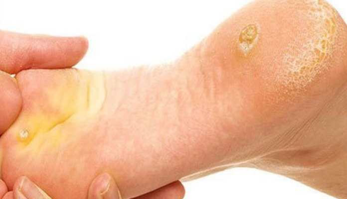 All You Need To Know About Corns And Calluses