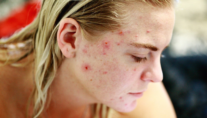 Effective Treatment For Acne Scars And Pimple Marks