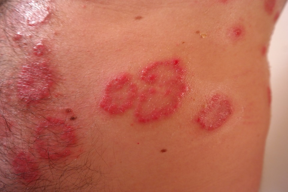 Treatment And Management Of Psoriasis