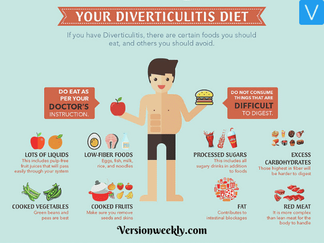 What to Eat & Not on Diverticulitis Diet Plan
