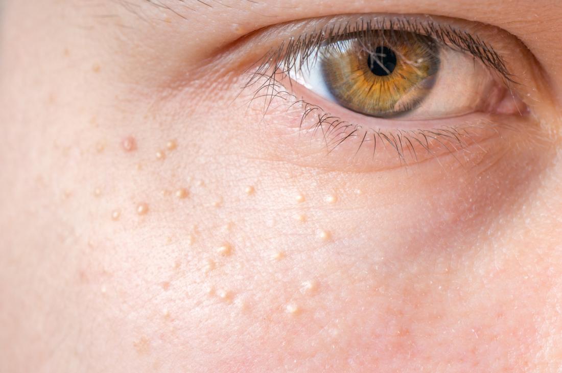 White Spots On Your Skin: 8 Possible Causes